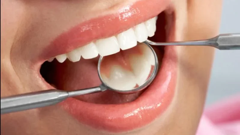 Endemia de fluorose dentária no sul de SC