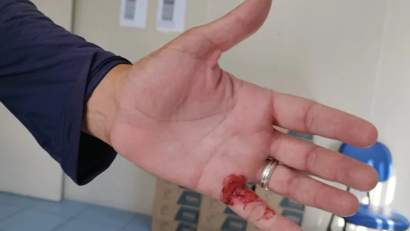 Leiturista de água é atacada por e ferido por cão enquanto trabalhava
