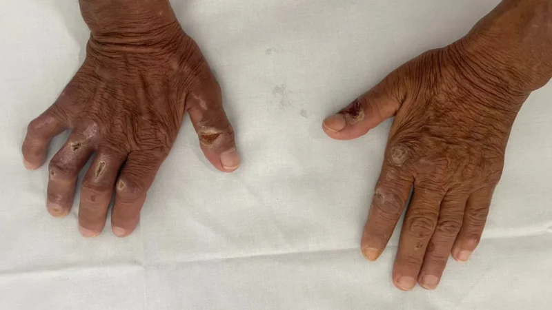 Combate à hanseníase reforça alerta para diagnóstico precoce e enfrentamento ao estigma
